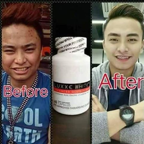 GOODBYE SKIN PROBLEMS!
"WE DON'T MAKE CLAIMS, WE DELIVER RESULTS"
🌟BEST SELLER🌟
#LUXXE_WHITE_ENHANCED_GLUTATHIONE
#SKIN_PROBLEMS_NO_MORE!!
✖DARK SKIN
✖UNEVEN SKIN
✖FRECKLES
✖PIMPLES
✖ACNE/ACNE MARKS .
✖YELLOWISH WHITE SKIN
✖DARK LIPS, ELBOW, KNEES, & ARM PITS
✖BIG PORES
✔BEST BRAND AWARD EXCELLENCE AWARDED as the
🏆MOST EFFECTIVE WHITENING SUPPLEMENT.
✔CONSUMERS CHOICE AWARDEE
🏆BEST WHITENING SUPPLEMENT & ANTI AGING
🏆NO. 1 SKINCARE PRODUCT
🏆MOST POWERFUL WHITENING SUPPLEMENT
✔Master Anti-Oxidant.
✔Eliminates Viruses, Bacteria and Toxins in the Body.
✔FDA, HALAL AND GMP APPROVED.
✅Prescribe by doctors.
✅💯% Made in USA.
✅Manufactured by AIE Pharmaceutical
✔Highest Form of Glutathione
✔High Quality
✔Glutathione Booster
✔food supplement not drugs.
✔no need for INJECTABLE .
✔no bad side effects.
✔Sun Protection
✔775mg
➖➖➖➖➖➖➖➖➖➖➖➖➖➖➖
O R D E R  H E R E ⬇
🔻SMS🔺 VIBER🔻WHATSAPP🔻
👉(+63919 676 8468)👈
➖➖➖➖➖➖➖➖➖➖➖➖➖➖➖ ✈International Orders
🆗 Bulk Orders accepted
🆗 RESELLERS ARE WELCOME! 🔍IMMUNE BOOSTER, VIT E(COLLAGEN), ANTI AGING, SLIMING, SOAP ⬇MORE PRODUCTS AT⬇
#FollowMyINSTAGRAM: 
@jushuaarriola_luxxeshopeph ❎🚫NO BOGUS BUYERS & JOY RESERVERS🚫❎ .
#beautysecrets #beauty #loveyourskin #whitening #whiteningproductph #bestwhiteningsupplement #brightesskin #skincare #safe #philippineonlineshop #philippines #USA #EUROPE #ASIA #Middleeast #authenticalproduct #officialdistributor #affordable #bestseller #Tagforlikes #likes4likes #Follow4Follow #instagood #pinayboobiiees