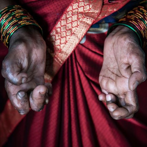 Most people think of leprosy as a disease long gone. But India is struggling with a resurgence. Health workers here thought they had vanquished leprosy in 2005. But it lived on, cloaked in stigma and medical mystery. Now India bears 60% of the world’s cases, according to @who. Leprosy often starts with discolored, numb patches or tiny nodules under the skin. Left untreated, it leads to deformities and permanent disability. There’s no blood test for the disease, and scientists aren’t entirely sure how it’s transmitted, although contact with infected people is sometimes the cause. That’s one reason why awareness is important. But “because of discrimination and prejudice, we don’t talk about it,” one health worker said. “And because we don’t talk about it, we don’t know who’s got leprosy and who doesn’t.” For more on how organizations are trying to help, visit the link in our profile. @khandelwal_saumya shot this photo.