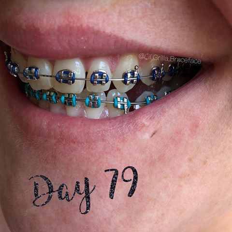 Day 79⛓Lil.Grilla.Mill✨🤩
💸Million dollar smile ⚠️ in progress 🦹🏼‍♀️
.
.
.
.
#adultbraces #dental #braceface #orthodontics #dentist #dentistry #mouth #beautiful #perfteef #braces #chompers #teeth #smile #workinprogress #mysmile #ding #nofilters #brackets #perfectsmile #beauty #selfcare #bracesafter30 #changingbite #changeisgood #painisbeauty #tabisteefies #lilgrillamill